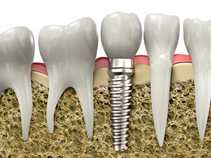 dental-implants