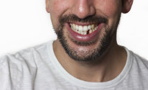 Missing <span>Teeth</span>