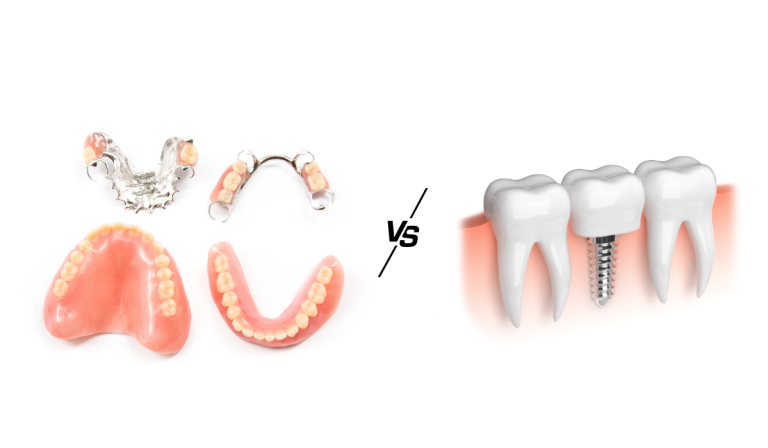 dental implants vs denture dentistry on sinclair