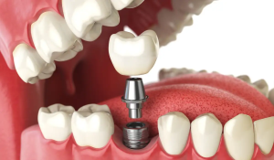Dental implants timeline stages at Dentistry On Sinclair Georgetown showing complete treatment process