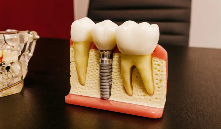 dental implants in acton