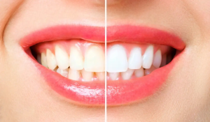 Cosmetic dentistry in Acton professional teeth whitening treatment at Dentistry On Sinclair