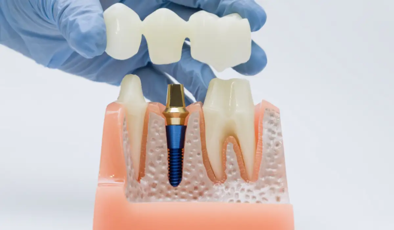Dental implants in Acton consultation and 3D imaging at Dentistry On Sinclair